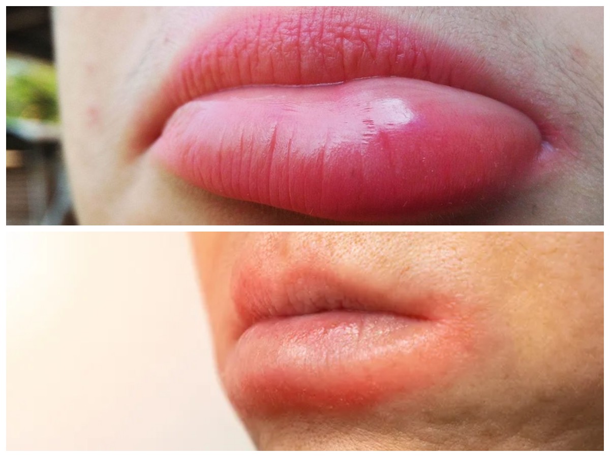 Kenali Penyebab Bibir Bengkak yang Umum dan Cara Mudah Mengatasinya