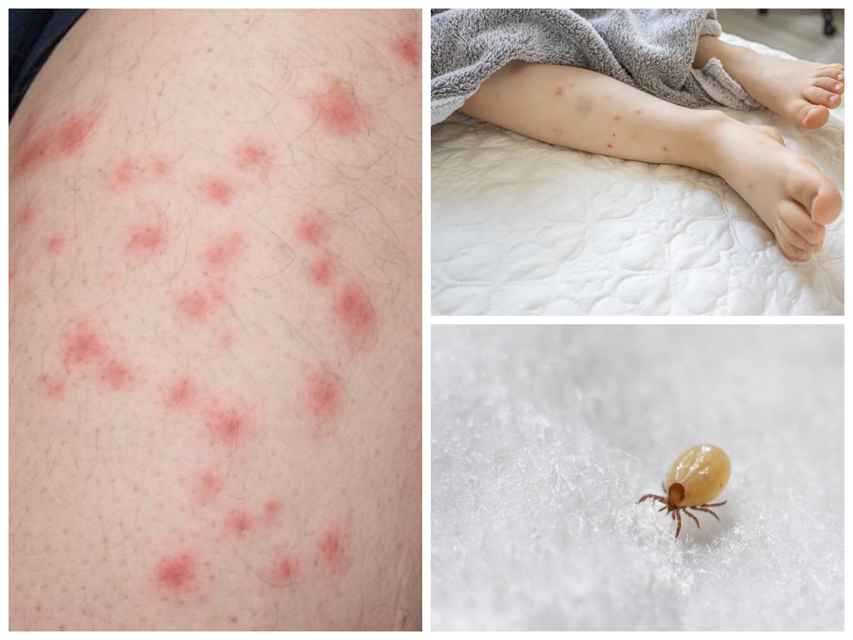 Gigitan Tungau Kasur: Penyebab, Bahaya bagi Kesehatan, dan Tips Ampuh Mengatasinya!