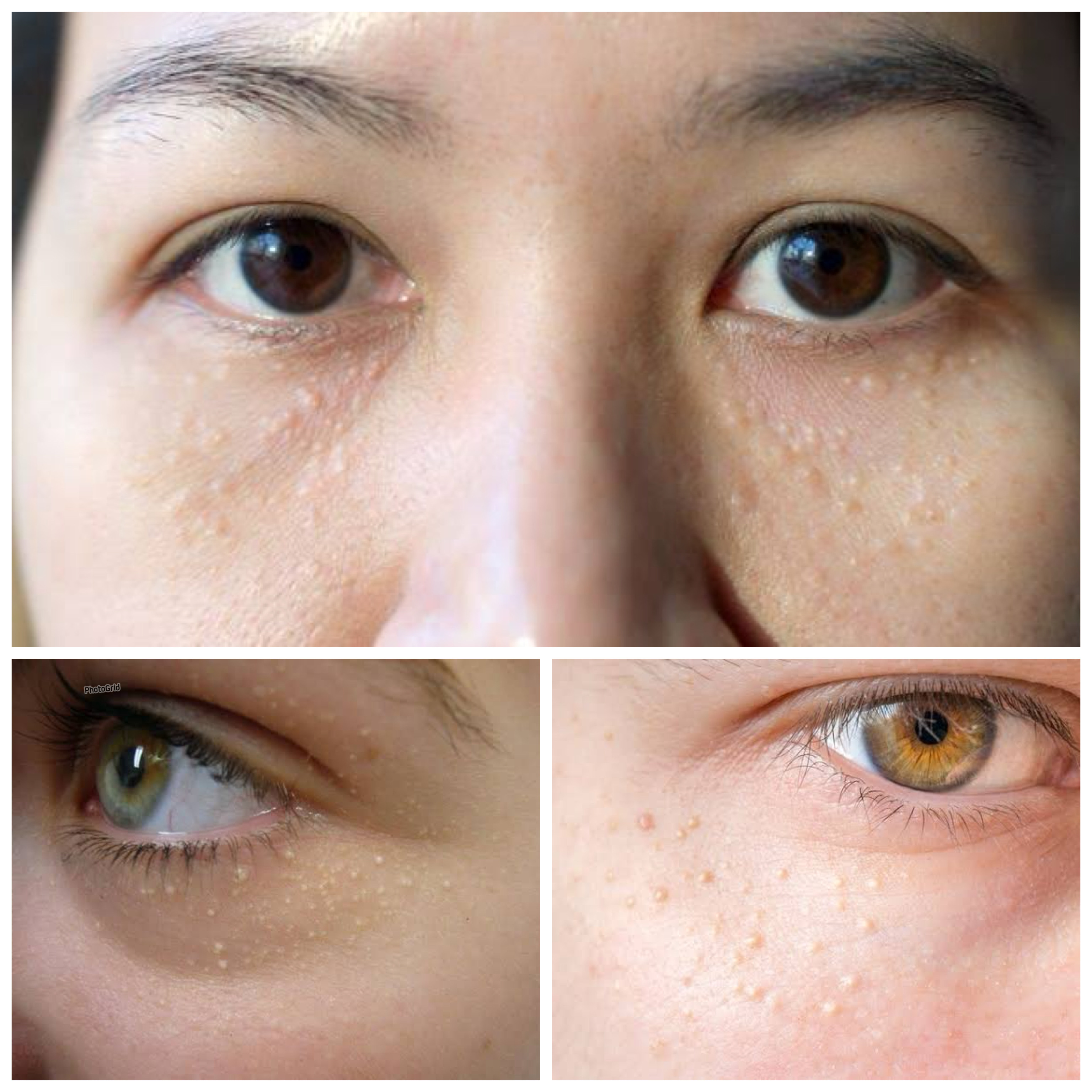 Kulit Cerah Bebas Milia: Tips dan Trik Menghilangkan Bintik Putih!