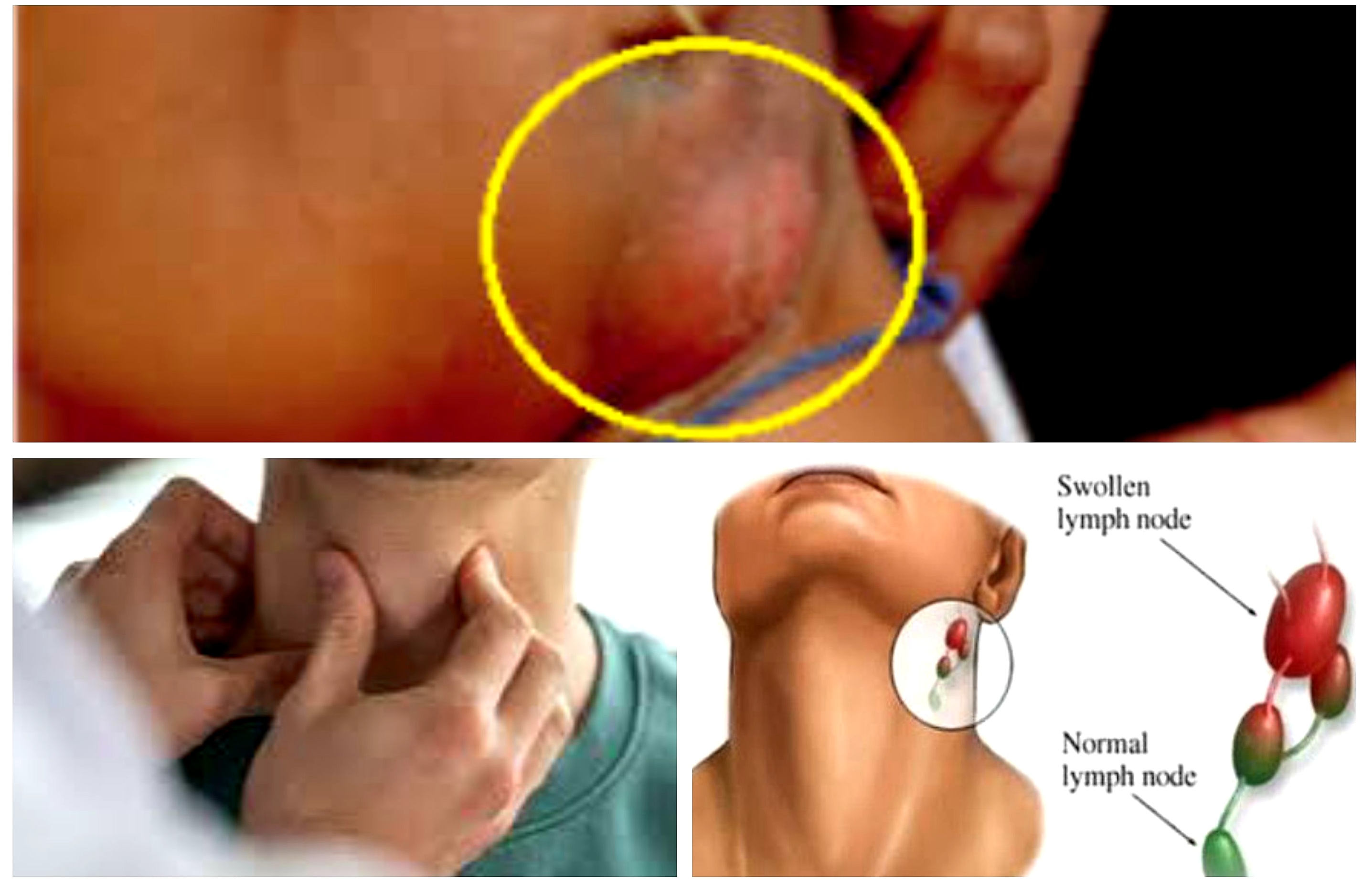 Getah Bening Langsung Kempes. Lakukan Langkah-langkah Pengobatan Ini