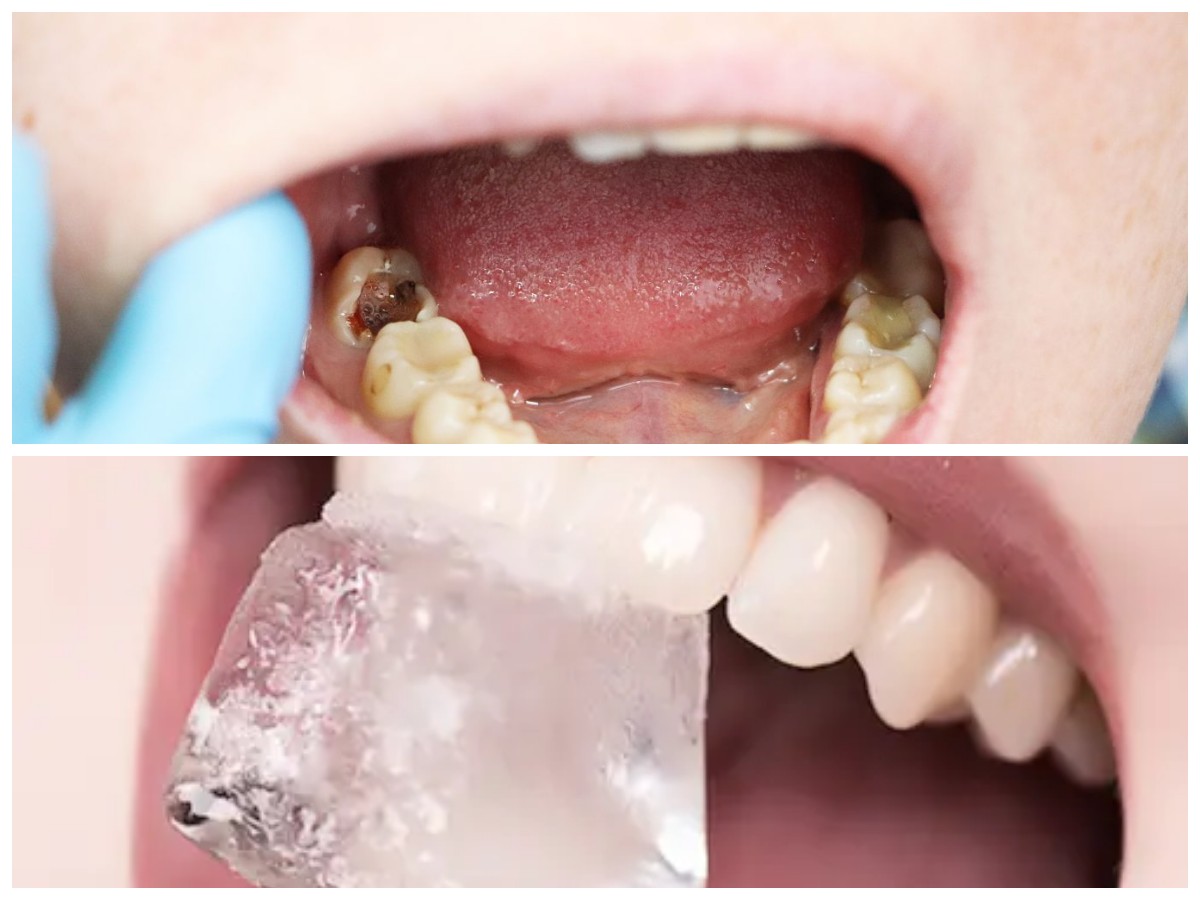 Cara Alami Mengatasi Gigi Berlubang agar Kembali Sehat dan Kuat!