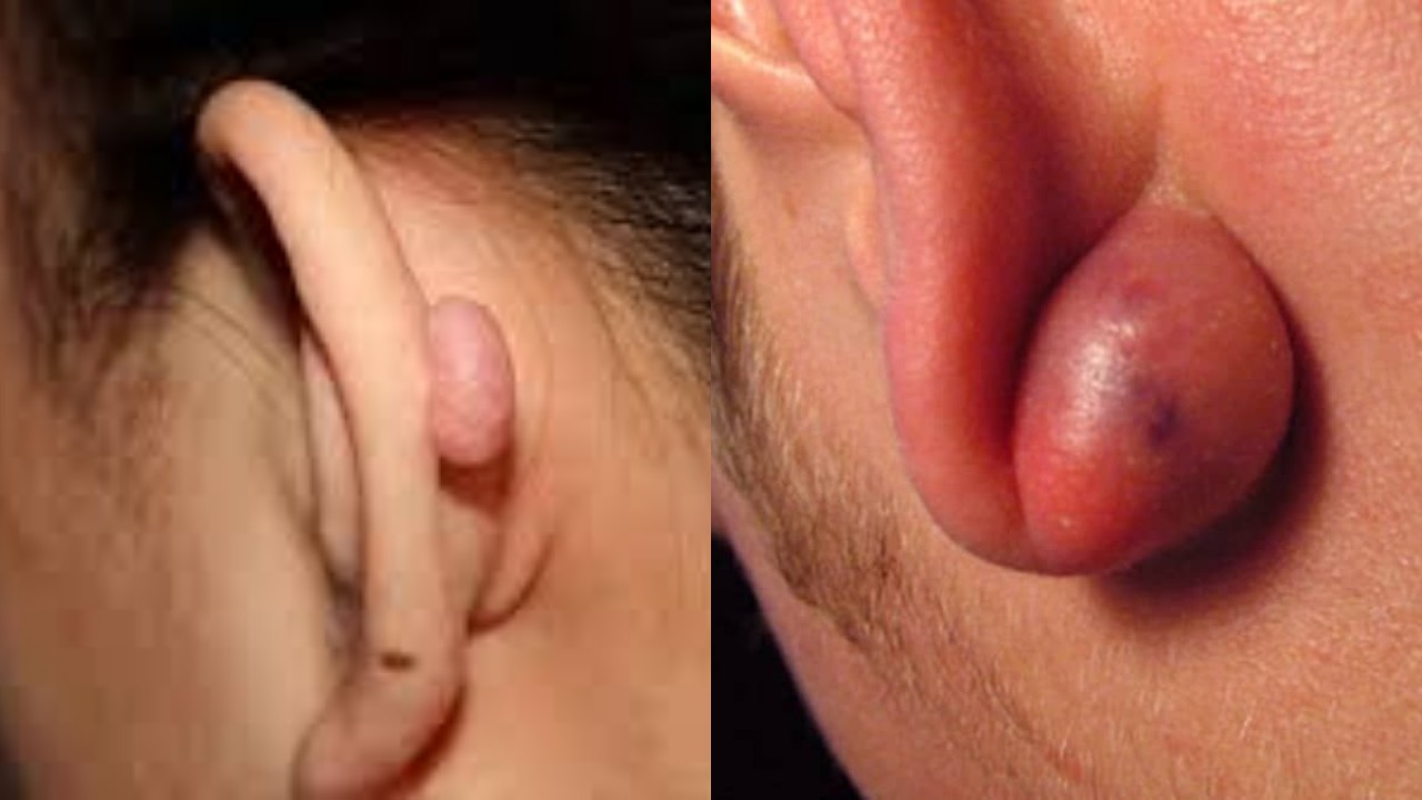 Penting! Mengenal Benjolan di Daun Telinga, Ketahui Penyebab dan Langkah Penanganannya