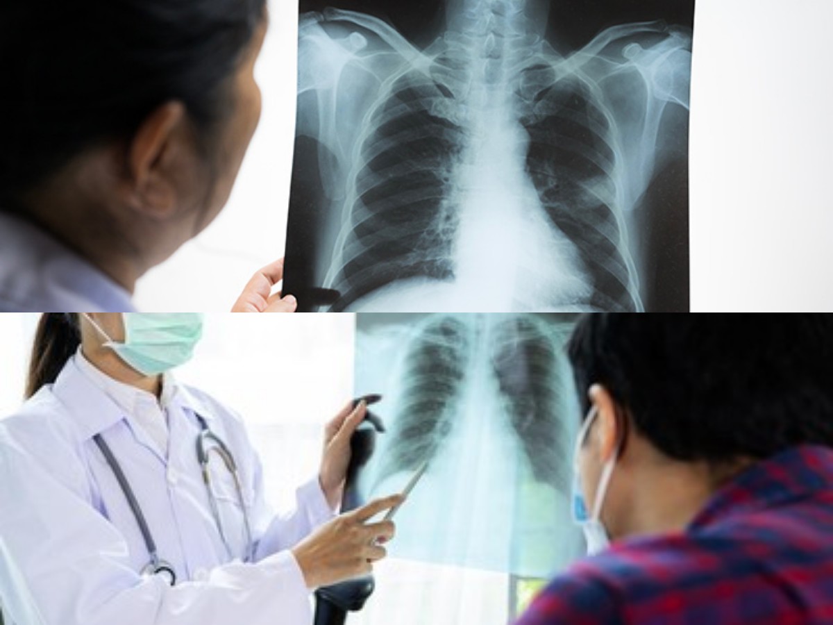 Penyakit TBC: Tantangan Global yang Masih Mengancam, Kenali Gejala, Penyebab, dan Pengobatannya