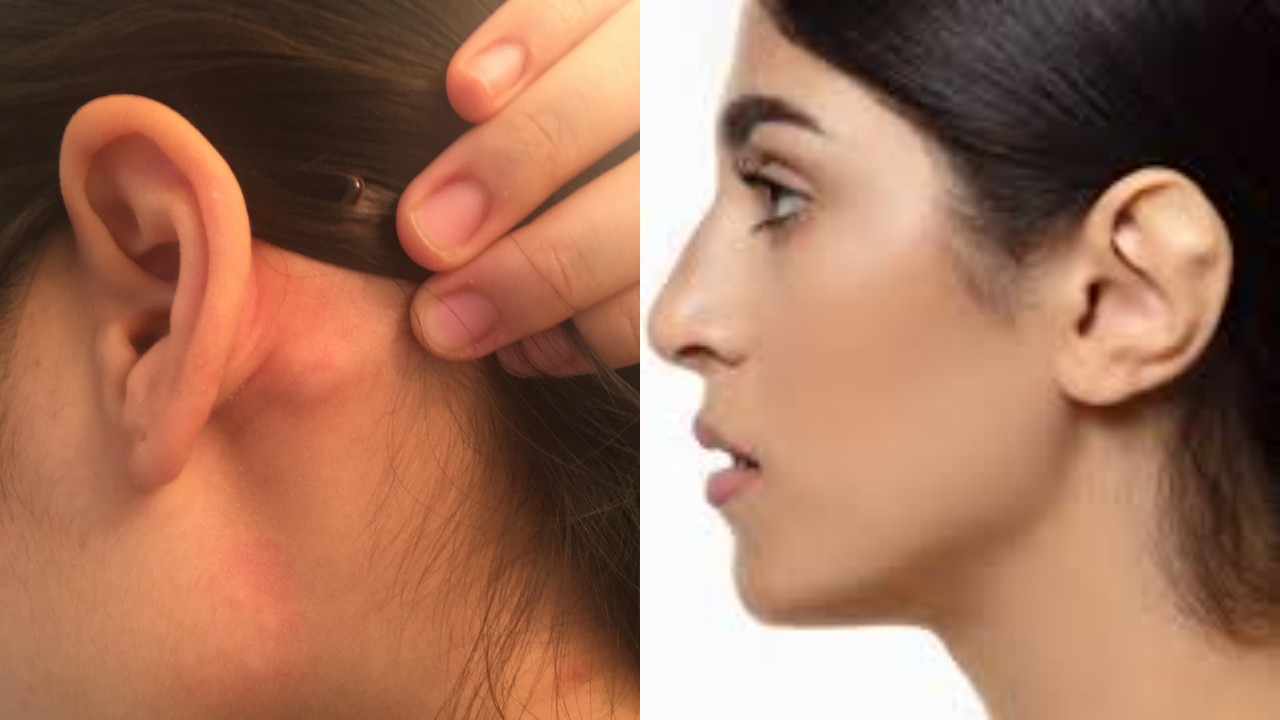 Jangan Khawatir Bila Muncul Benjolan di Daun Telinga ini Tips Cara Ampuh Mengatasinya?