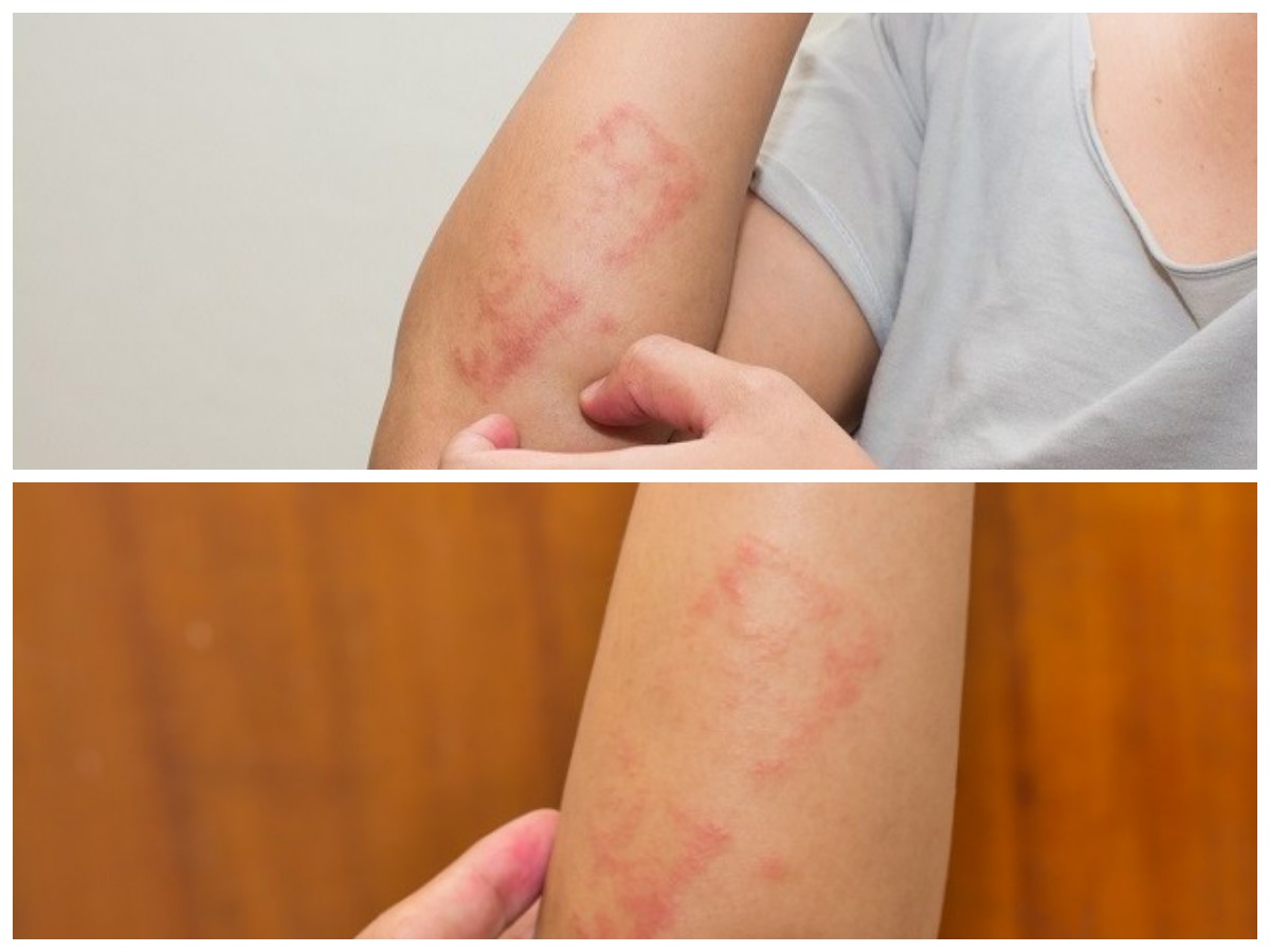 Gejala Alergi Jamur yang Sering Diabaikan dan Cara Efektif Mengatasinya