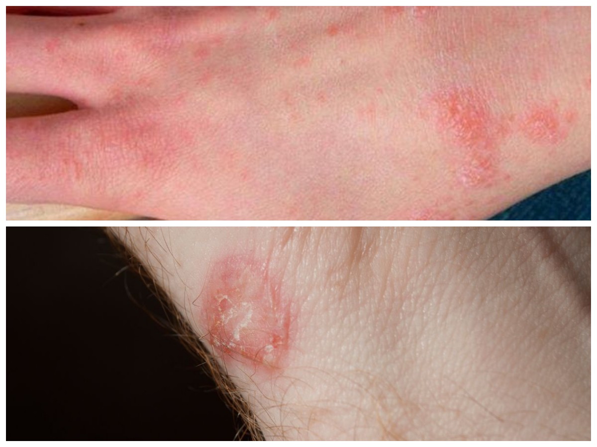 5 Infeksi Kulit Akibat Bakteri yang Perlu Diwaspadai dan Cara Mengobatinya