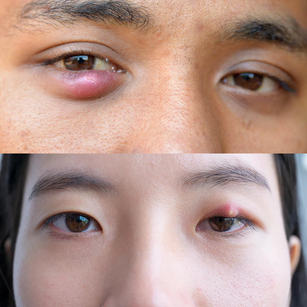 Wajib Diketahui 7 Penyebab Mata Bintitan dan Cara Mengatasinya!