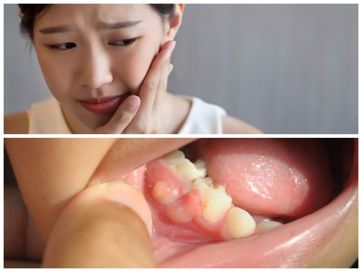 10 Langkah Sederhana Atasi Gusi Bengkak dan Berdarah Secara Alami