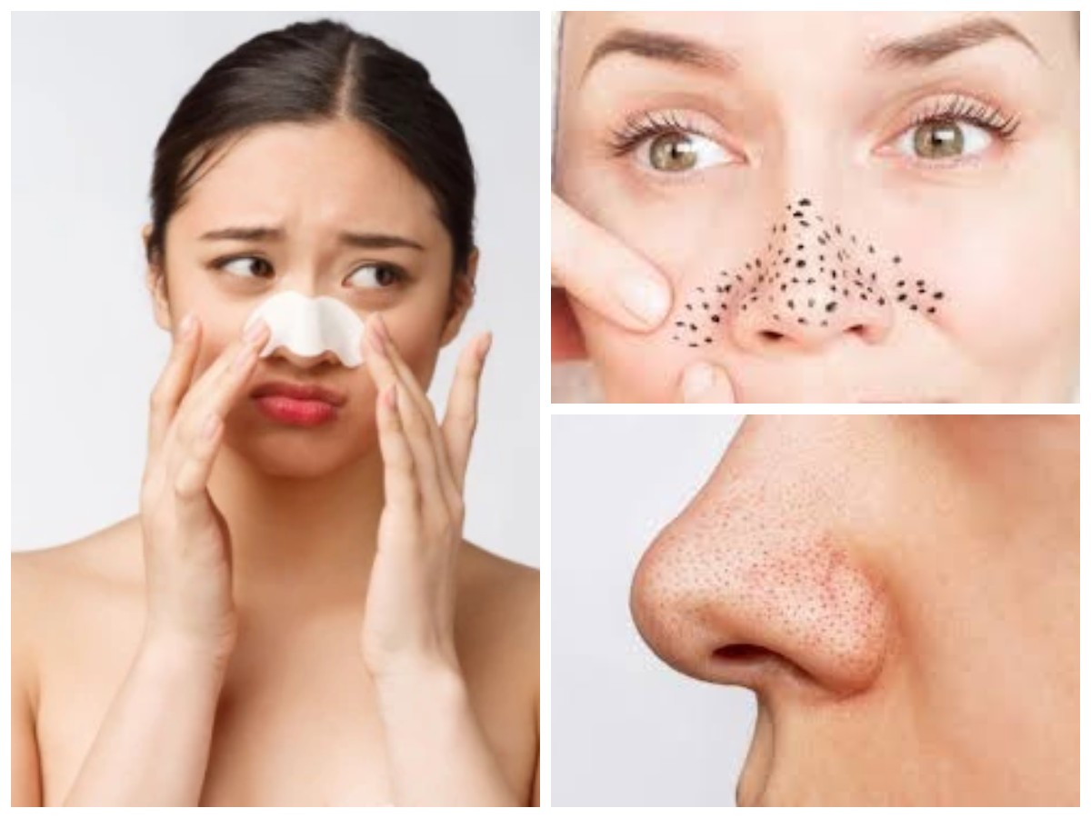 Beragam Tips menghilangkan Komedo Pada hidung Secara Alami!