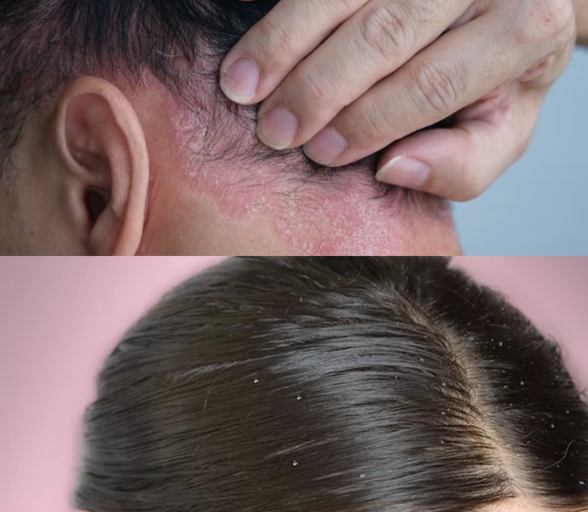 Sama-sama Menimbulkan Gatal, Berikut Perbedaan antara Ketombe dan Dermatitis Seboroik