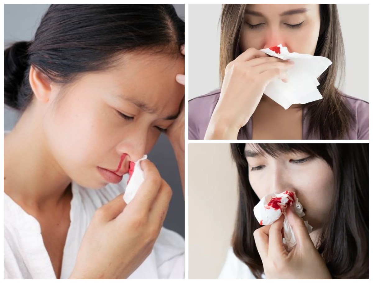 Sering Mimisan? Kenali Penyebab, Cara Mengatasi, dan Tips Pencegahannya agar Tidak Terulang Lagi!