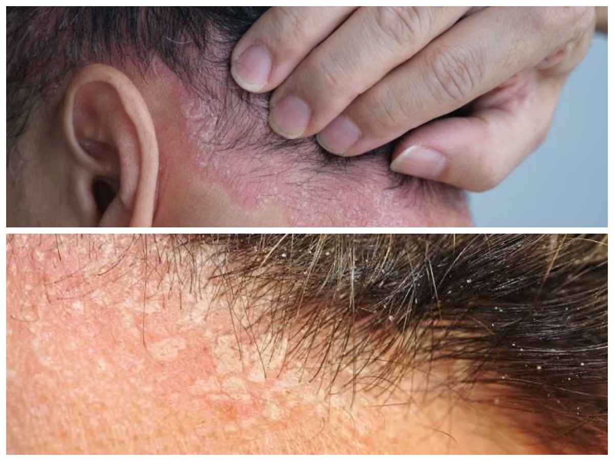 Ketombe vs Dermatitis Seboroik: Kenali Perbedaan, Penyebab, dan Cara Mengatasinya