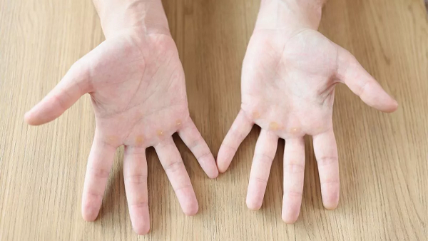 Mata Ikan di Tangan? Jangan Khawatir, Begini Cara Mengatasinya!