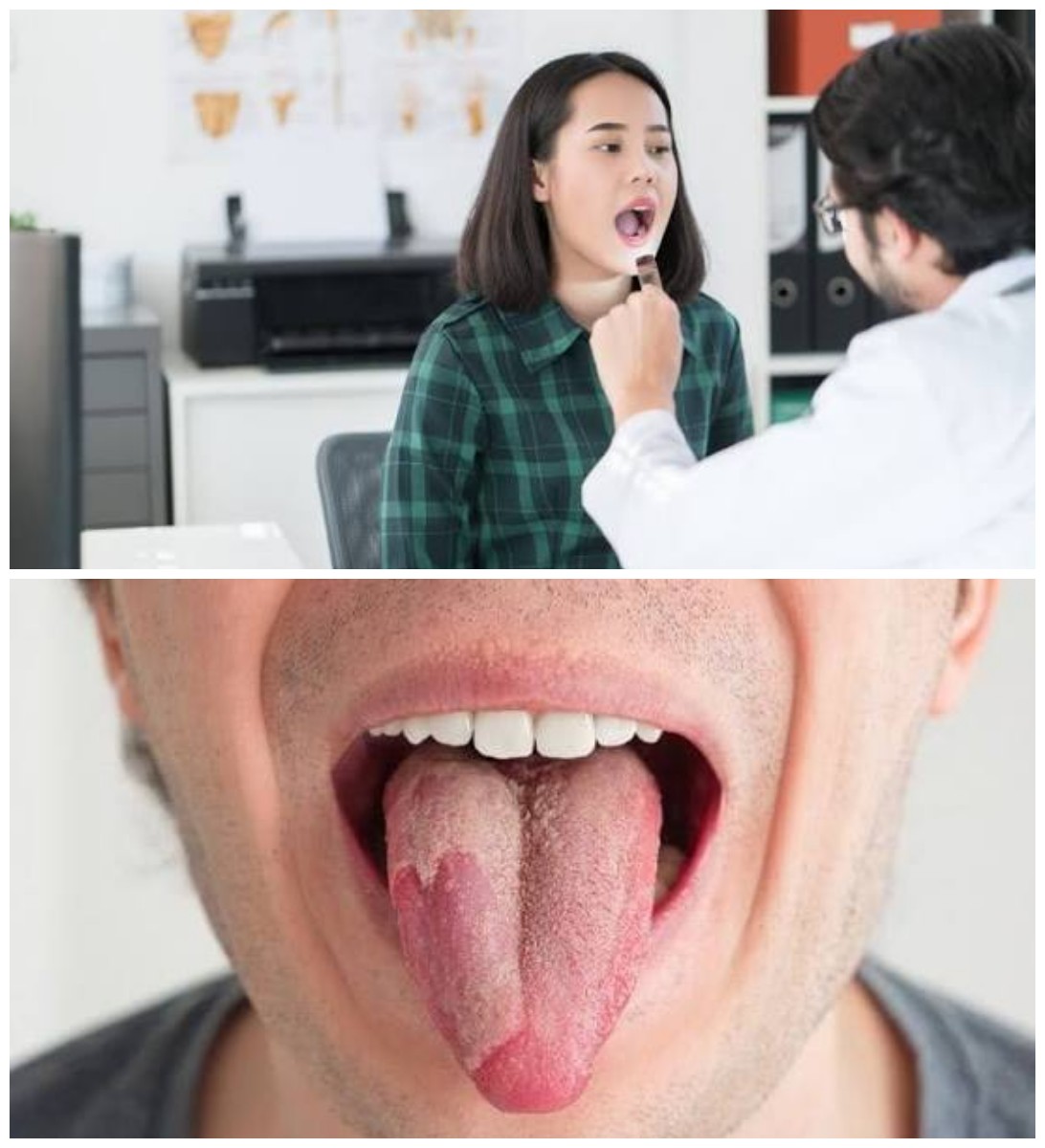 8 Langkah Efektif Meredakan Radang Lidah (Glossitis) Secara Tepat