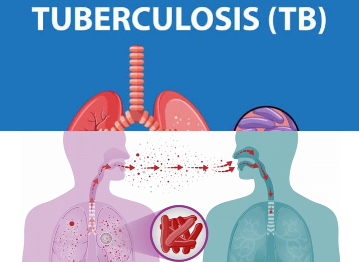 Meningkatnya Kasus Tuberkulosis: Pentingnya Deteksi Dini untuk Menyelamatkan Nyawa dan Mencegah Penyebaran