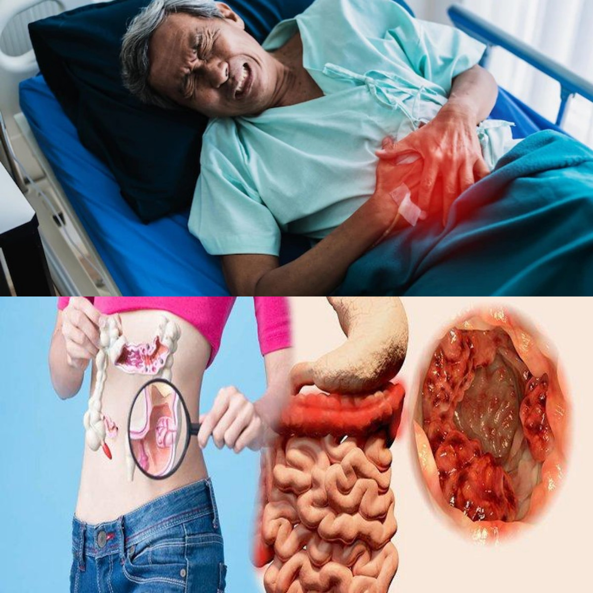 Kanker Usus Besar! Gejala, Penyebab, Dan Cara Mengobati Yang Perlu Diketahui  