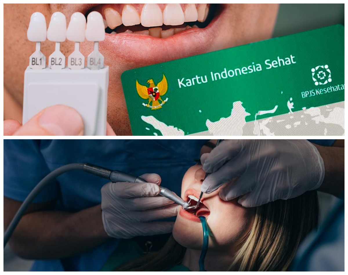 Gratis! 7 Perawatan Gigi yang Ditanggung BPJS Kesehatan, Mulai dari Tambal hingga Pasang Gigi Palsu