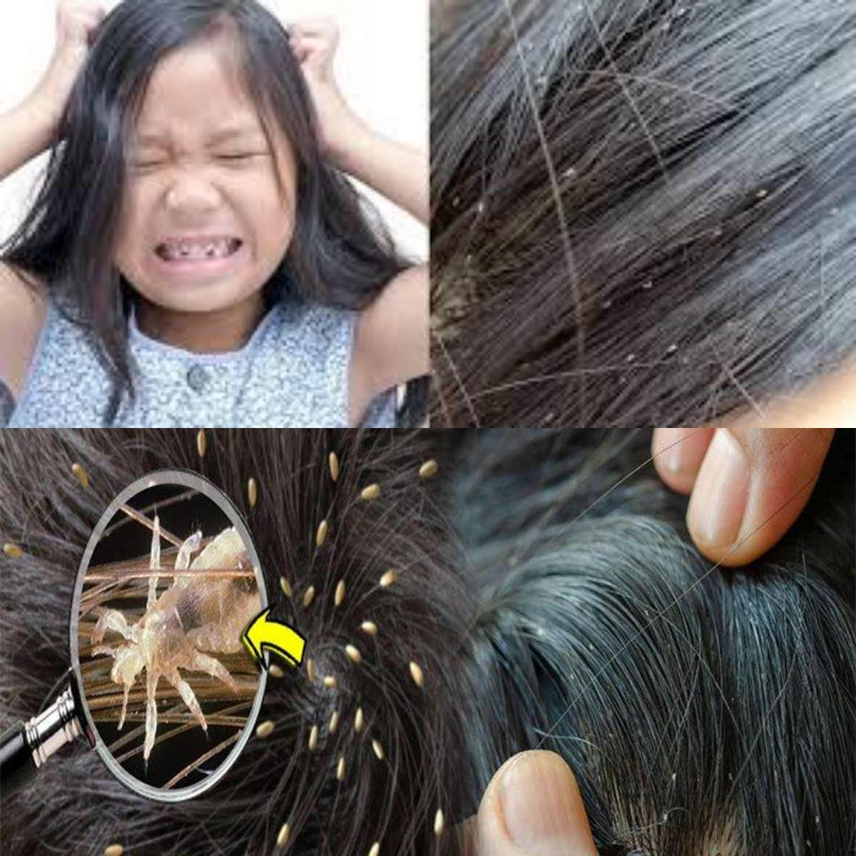 Inilah Rekomendasi Obat Kutu Rambut Terbaik!