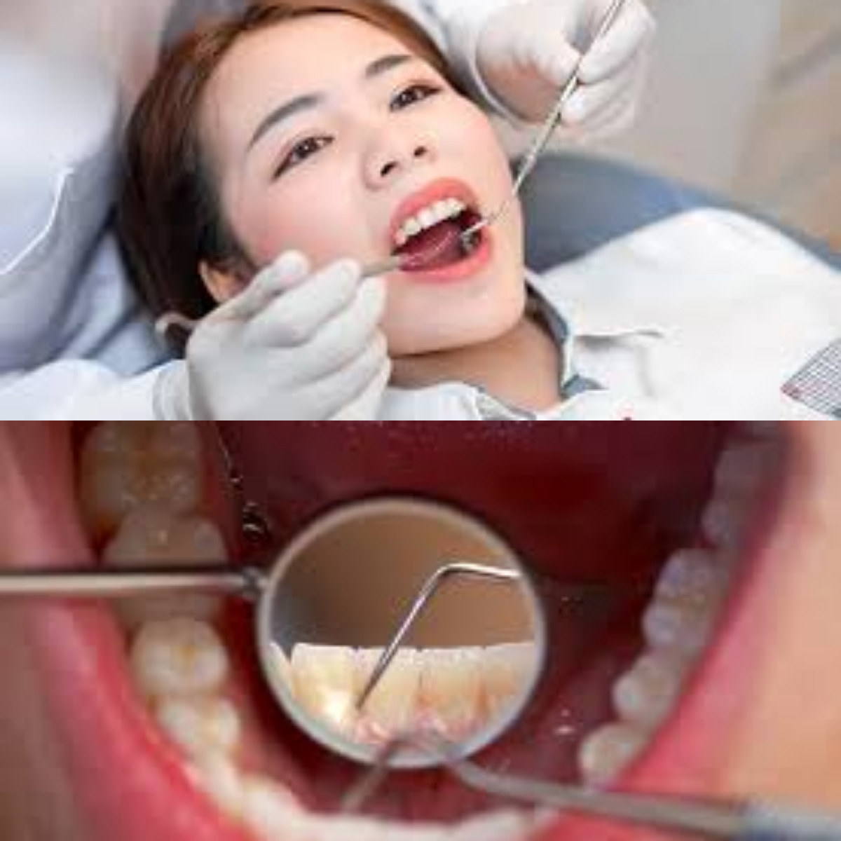 Inilah 5 Cara Membersihkan Karang Gigi Sendiri!  