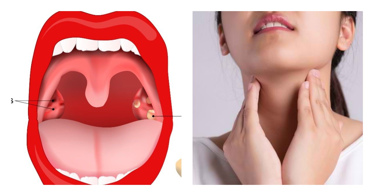 Kenali Penyebab Batu Amandel dan Cara Mengatasinya