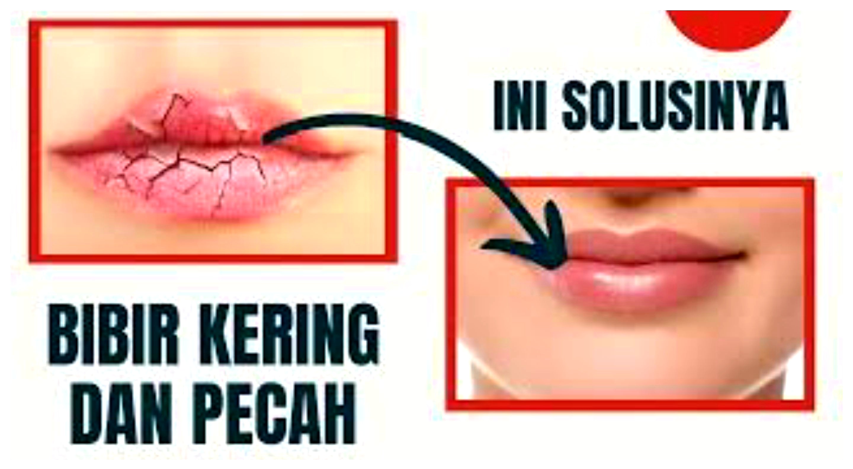 Bukan Karena Panas Dalam. Ternyata Ini Penyebab Bibir Pecah-pecah dan Cara Mengatasinya