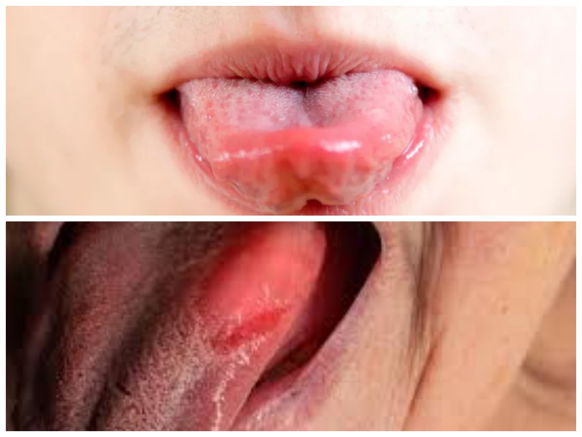 Tips Ampuh Meredakan Radang Lidah Agar Aktivitas Sehari-hari Tidak Terganggu