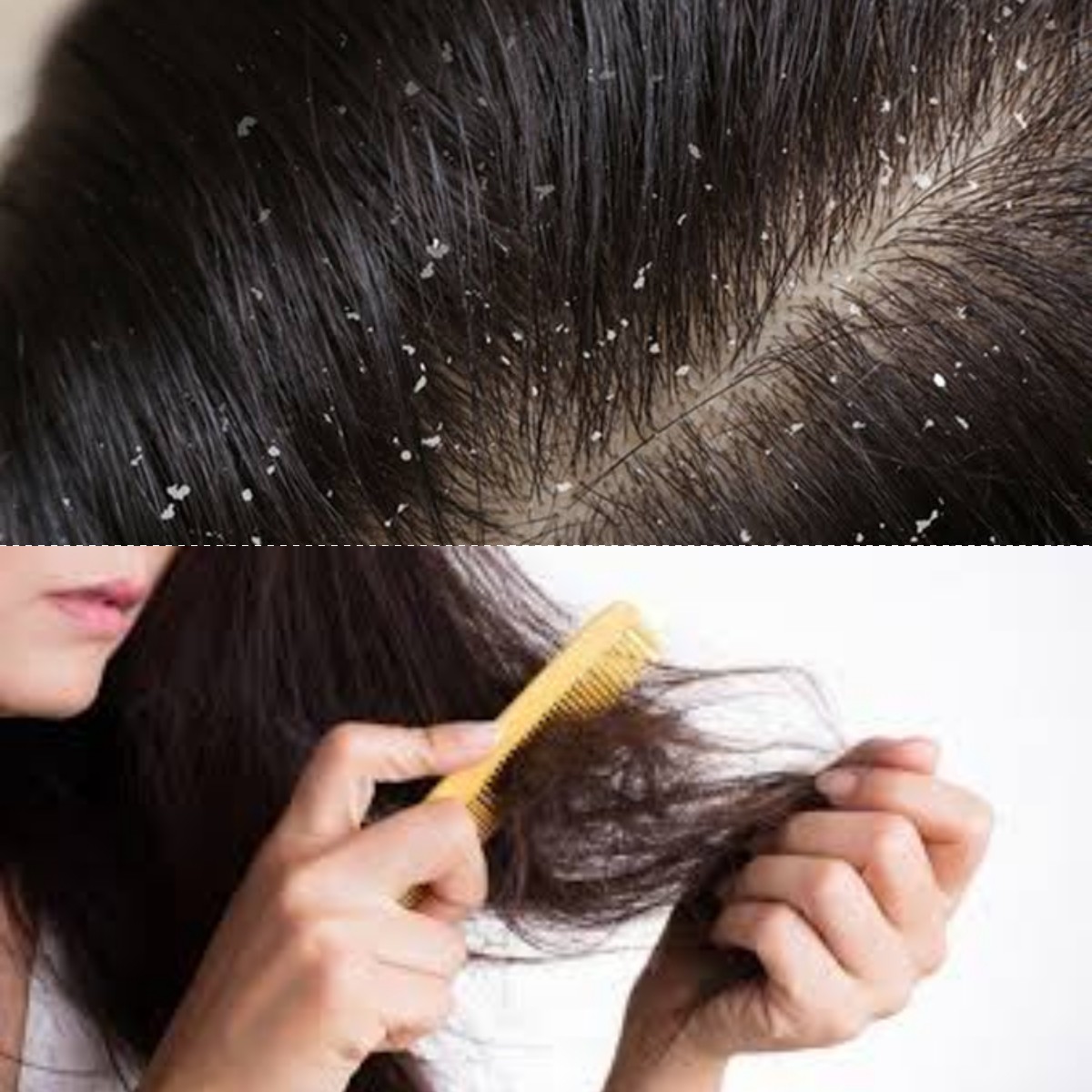 Rambut Rontok dan Ketombe Kombinasi Masalah yang Sering Disepelekan