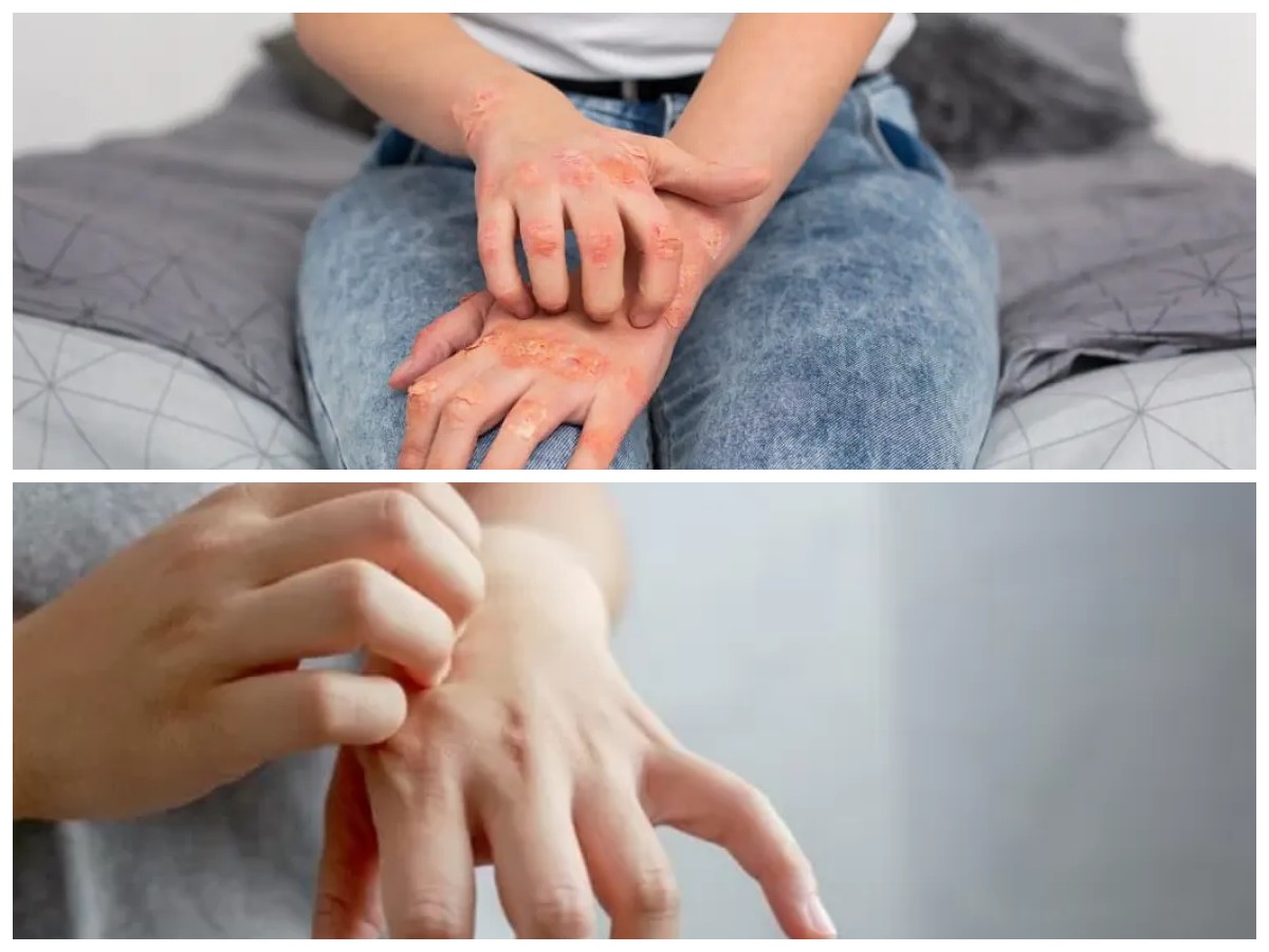 Jangan Anggap Sepele! Begini Cara Membedakan Gatal Biasa dengan Gatal Akibat Diabetes