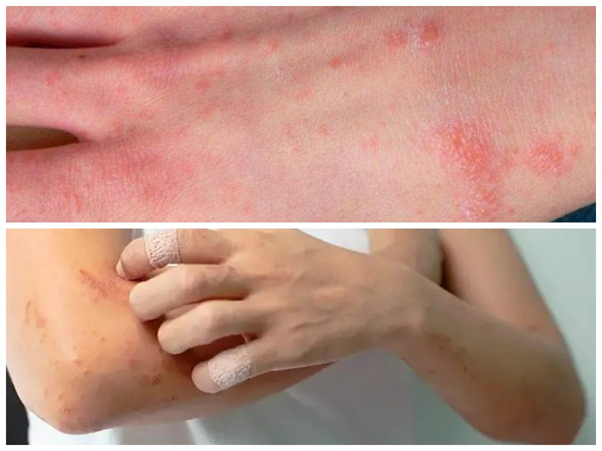 Kenali Infeksi Kulit Bakteri: Dari Tanda Awal hingga Penanganan Tepat