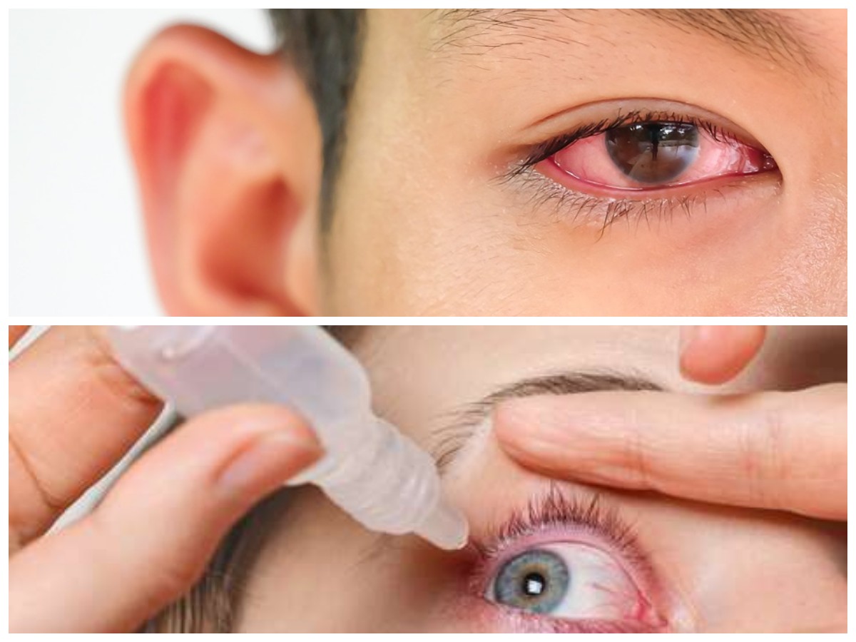 Mata Merah Gara-gara Polusi? Ini Solusi Mudah yang Bisa Kamu Coba!