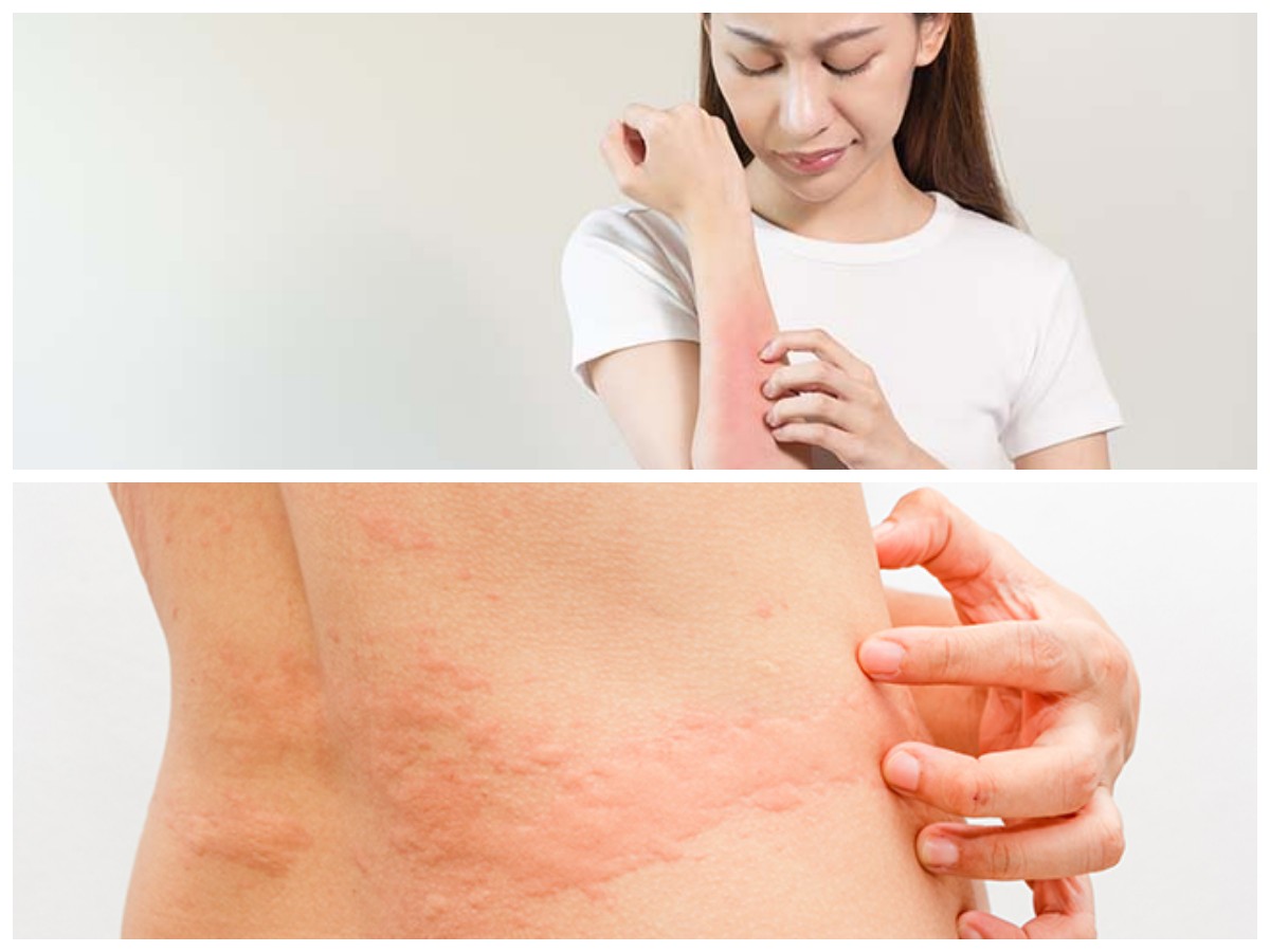 Obat Biduran dari Bahan Alami: Solusi Herbal untuk Gatal dan Ruam