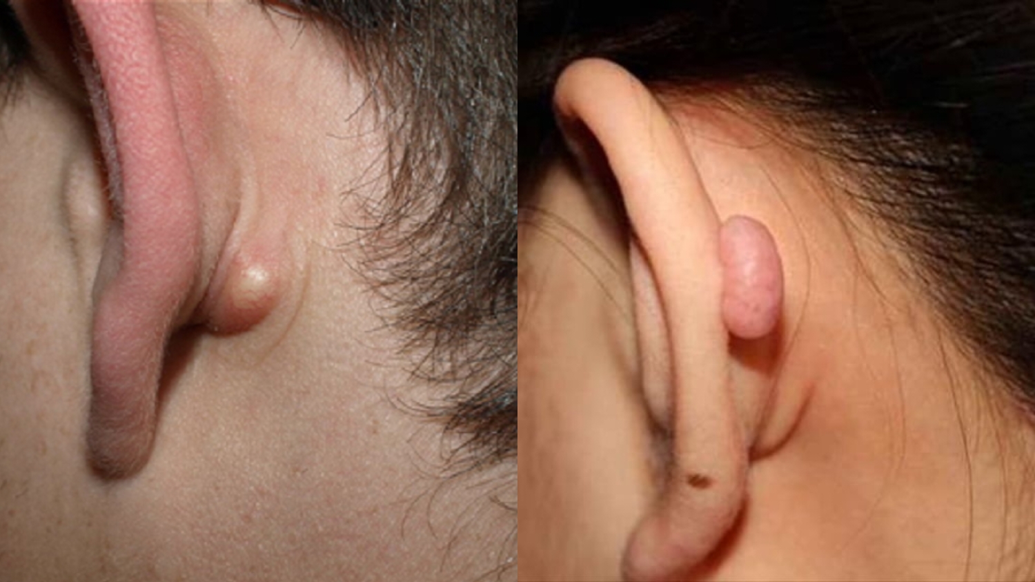 Teryata Ini Penyebab Benjolan Ditelinga Efeksi! 