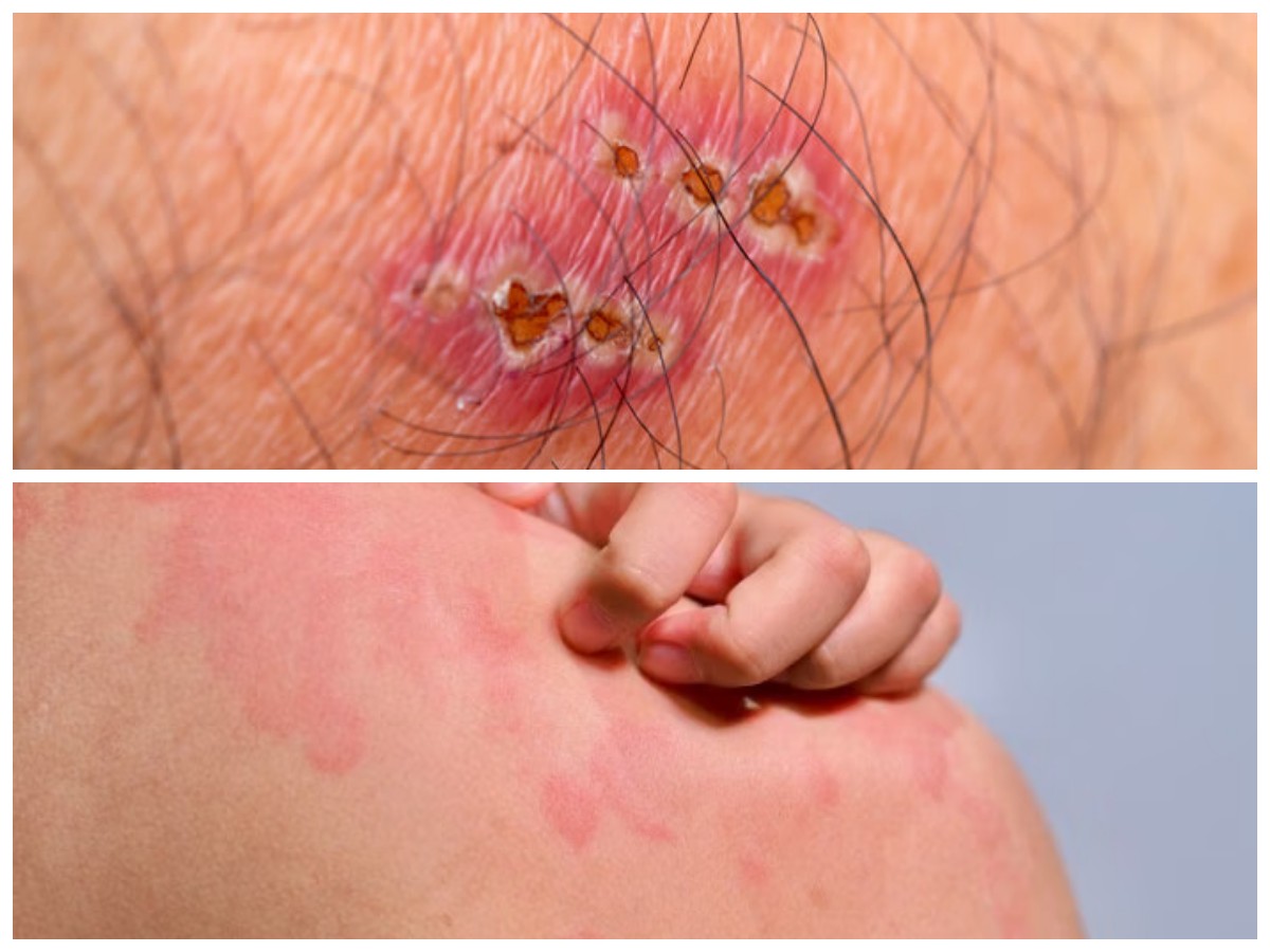 Kenali 5 Jenis Infeksi Kulit karena Bakteri Lengkap dengan Cara Penanganannya