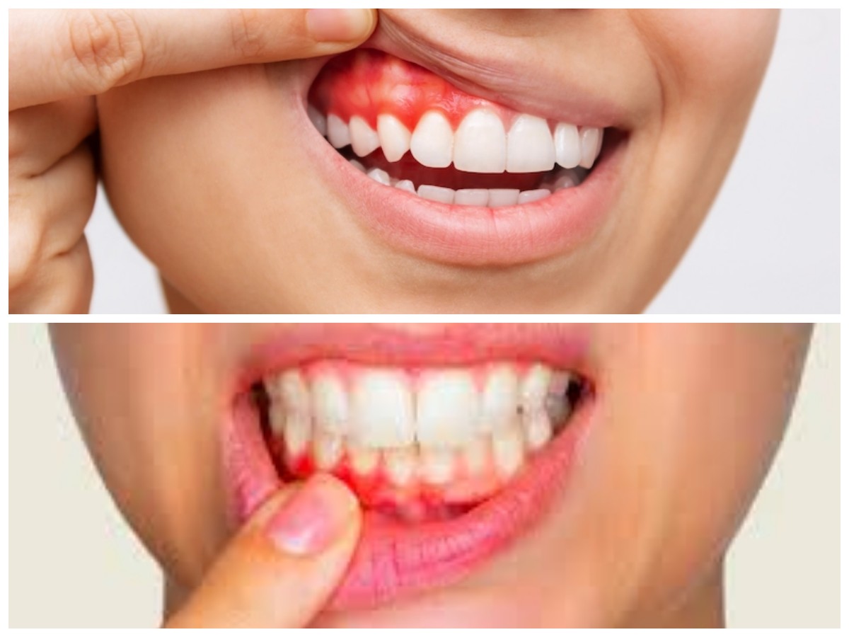 Solusi Cepat dan Tepat Atasi Gusi Bengkak Berdarah Agar Kembali Sehat