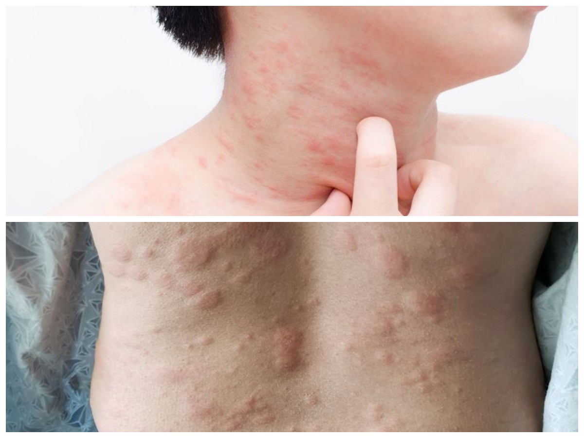 Cara Alami Atasi Biduran: Ramuan Herbal Ampuh untuk Kulit Sehat