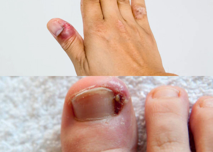 Cara Menyembuhkan Cantengan yang Cepat dan Efektif!