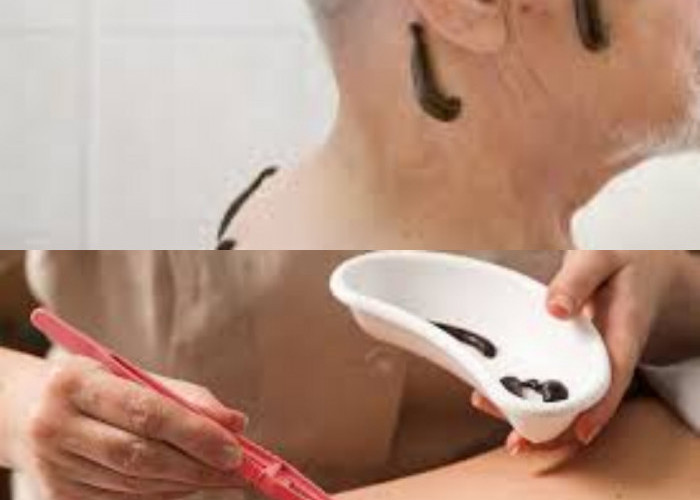  Wow Yuk Simak Terapi Lintah, Ini 5 Manfaatnya untuk Kesehatan!