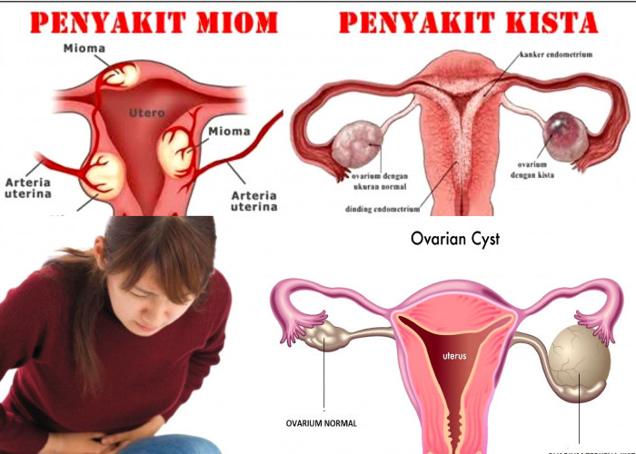 Momok Bagi Wanita. Yuk Mengenal Tumor Rahim dan Kista. Ini Penjelasannya