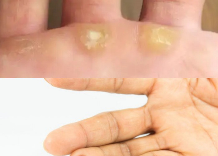  Mata Ikan di Tangan, Pahami Alasan dan Metode untuk Menyingkirkannya