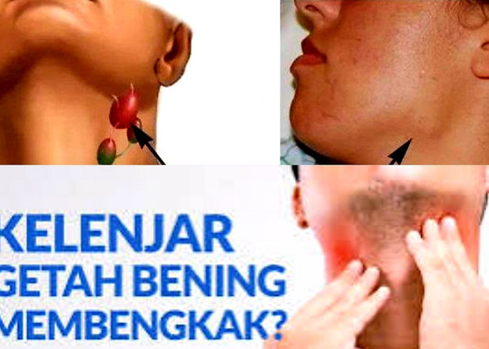 Kuatir Karena Pembengkakkan Getah Bening? Ini Tips Pengobtan dan Meredakannya