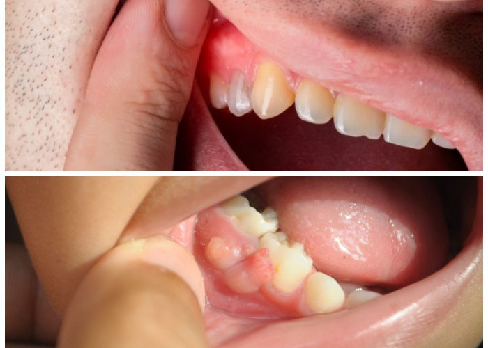 Cara Ampuh Mengatasi Gusi Bengkak dan Berdarah dengan 10 Langkah Praktis