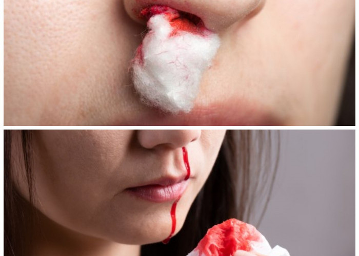 Mimisan Tidak Lagi Menakutkan: Penyebab, Penanganan, dan Cara Mencegahnya