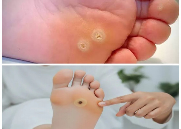 Sering Mengganggu Aktivitas? Ini 5 Tips Ampuh Mengatasi Mata Ikan di Tangan Sampai Tuntas!