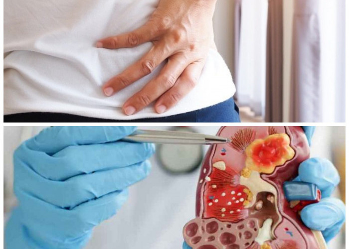 Cara Tepat Menangani Penyakit Ginjal di Stadium Awal agar Tidak Bertambah Parah