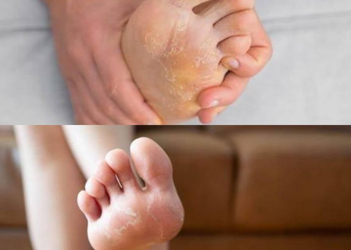 Kembali Mulus Bebas Gatal! Ini Cara Ampuh Mengatasi Kulit Kaki Pecah-Pecah dan Mengelupas