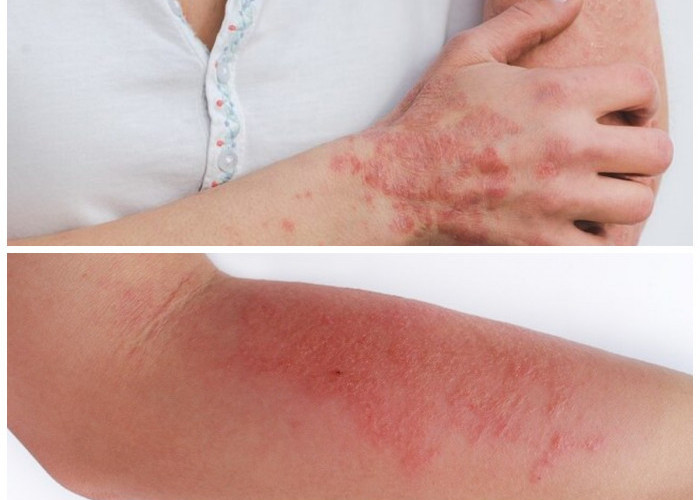 Alergi Daging Merah Bikin Tidak Nyaman? Ini Gejala yang Perlu Dikenali dan Tips Penanganannya!