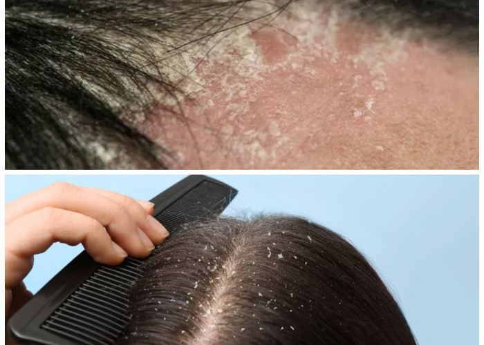 Tips Efektif Menyingkirkan Ketombe yang Sulit Hilang