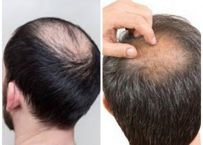 Bosan Mengalami Kebotakan? Kenali Penyebab dan Tips penumbuhan rambut!