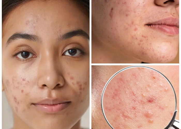 Tips Menghilangkan Bekas Jerawat Hitam Secara Alami: Cara Ampuh Merawat Kulit Wajah agar Kembali Cerah!