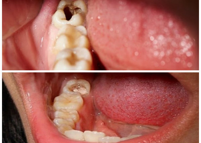 Gigi Berlubang Mengganggu? Yuk, Coba Tips Perawatan Alami Ini!